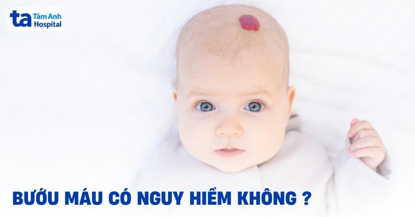 Bướu máu có nguy hiểm không? Có bao nhiêu cấp độ bệnh ở trẻ em?