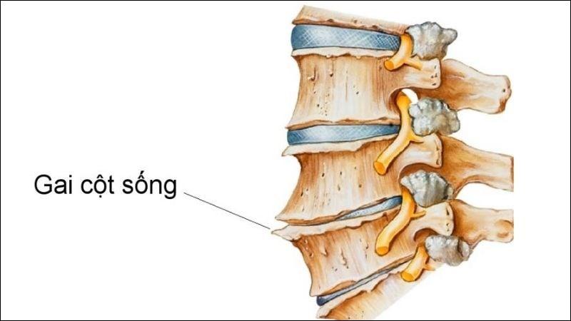 7 cách chữa gai cột sống có thể bạn chưa biết