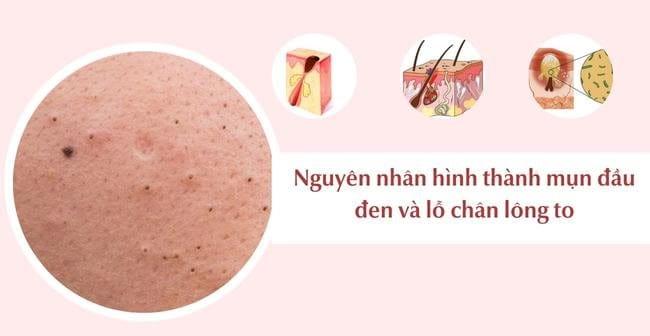 Nguyên nhân hình thành mụn đầu đen và lỗ chân lông to