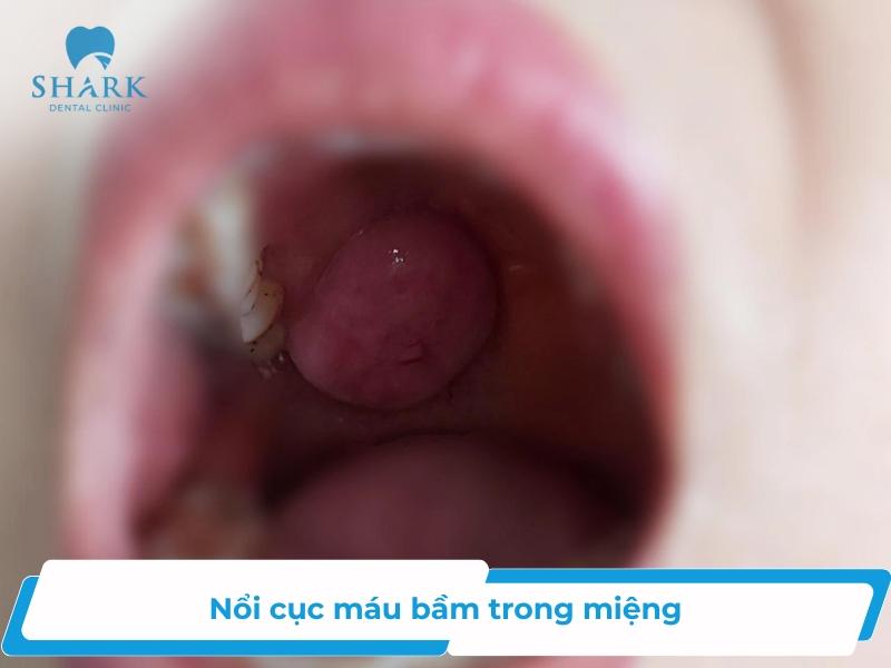 Nổi cục máu bầm trong miệng là bị gì?