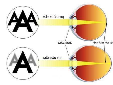 Ngày nay, cận thị là một trong các tật khúc xạ phổ biến nhất