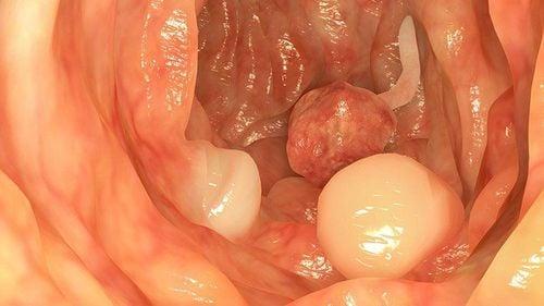 Tất cả những điều bạn cần biết về polyp