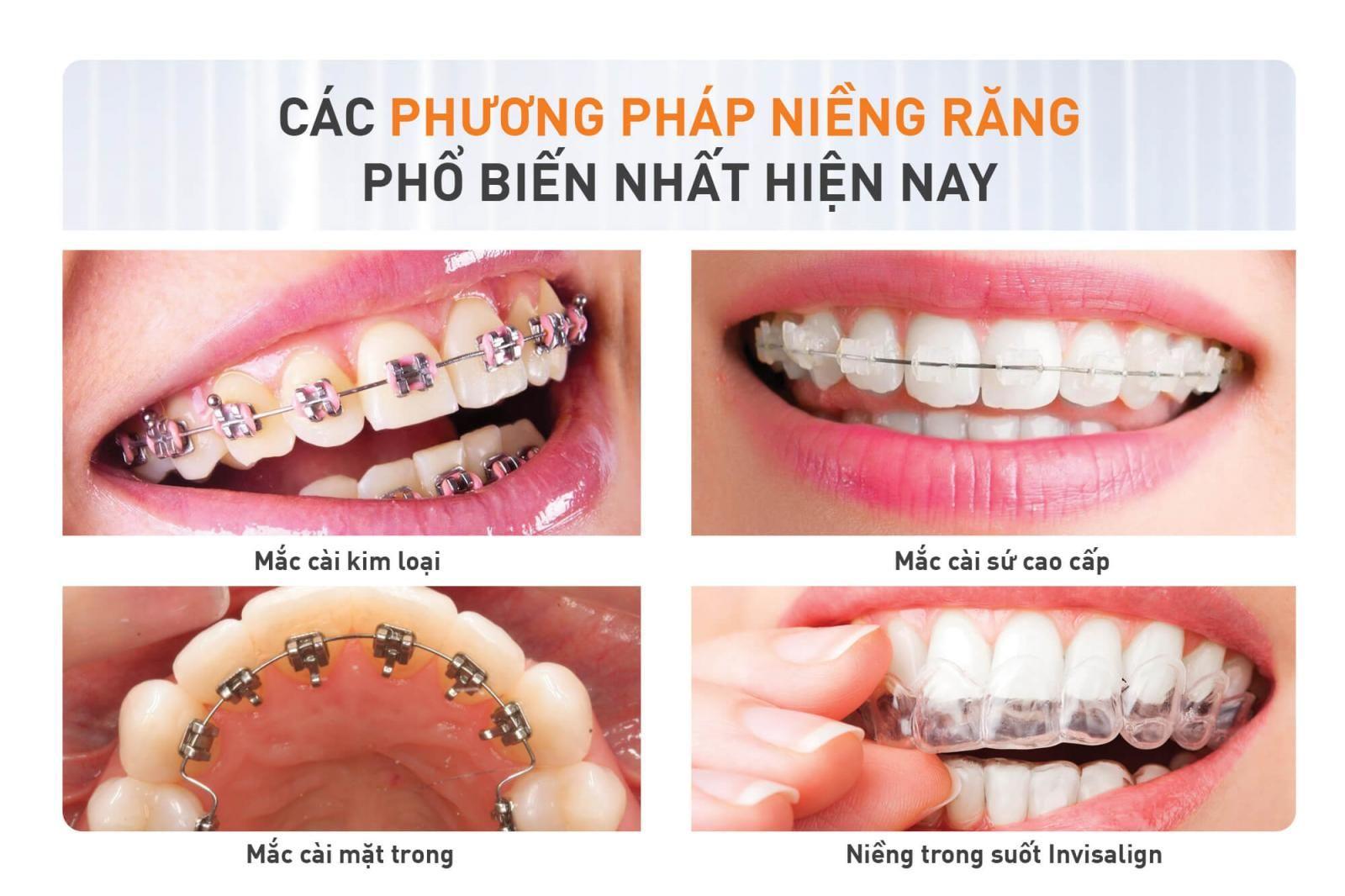 Niềng răng bao nhiêu tiền [09/2024]. Giá niềng răng mới nhất