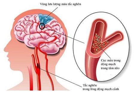 Đột quỵ: Nguyên nhân, dấu hiệu nhận biết, cách phòng tránh