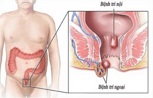 Điều trị trĩ ngoại: Những điều cần biết