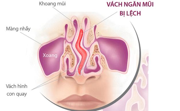 hình ảnh lệch vách ngăn mũi